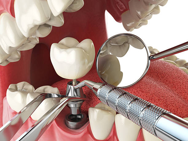 Best Emergency Dental Care for Abscessed Tooth in Blue Ridge, GA